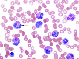 Eosinophilia Hematology And Oncology Msd Manual