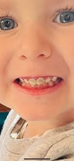 Are the front right crown and teeth too big or low?