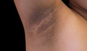 Maybe you would like to learn more about one of these? Diabetes Type 2 Symptoms High Blood Sugar Signs Include Dark Skin Patch Express Co Uk
