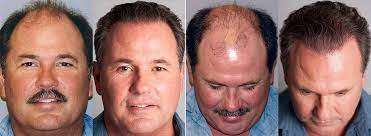 8 fl oz (pack of 1) 4.3 out of 5 stars 13,256. Hair Restoration Before After Images