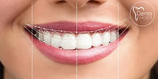 Gülüş Tasarımı (Hollywood Smile)