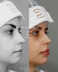 Botox|Bioestimulador|Fios de PDO|Clinica GV