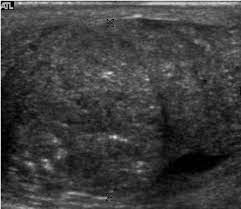Although they are not dangerous as cancers, they may need. Embryonal Cell Carcinoma Longitudinal Ultrasound Image Of The Testis Download Scientific Diagram