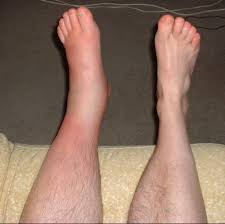 Après une journée à piétiner vos jambes sont lourdes et inconfortables ? Jambes Enflees