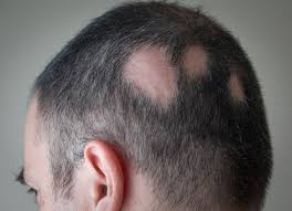 Although most commonly used to treat the skin condition psoriasis, anthralin cream or paste can also be administered to treat alopecia, or hair loss. Alopecia Areata Treatment Information Encinitas West Dermatology