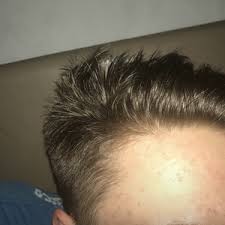 We provide the largest selection of high quality hair products anywhere. Is My Hair Starting To Recede On One Side My Temple Looks Unusual Compared To The Other Advice Photos
