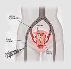 Aunque muchos son pequeños y no causan síntomas, e n algunas ocasiones, pueden adquirir mayores tamaños y causar dolor abdominal intenso, entre otros síntomas. Embolizacion De Fibromas Uterinos Ufe Ara Diagnostic Imaging