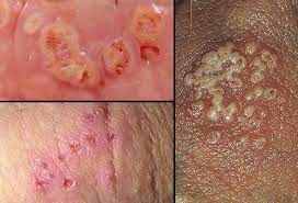 Commonly, ingrown hair looks like genital herpes when it is not. Genital Herpes Causes Treatment And Prevention