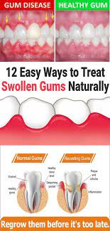 12 Easy Ways To Treat Swollen Gums Naturally Swollen Gum Receding Gums Gum