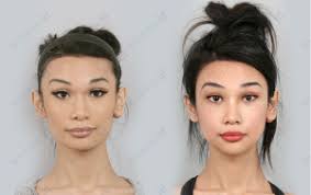 Facial Feminization Surgery In Korea Ffs Id Hospital