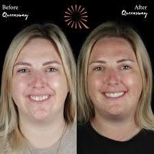 🌟 From Shadow to Shine 🌟 This lovely patient visited Queensway Dental  hoping to bring more balance and brightness to her smile. Her biggest  concern was her two front teeth, particularly one