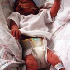 Clubfoot describes a range of foot abnormalities usually present at birth (congenital) in which your baby's foot is twisted out of shape or position. Photos Of Babies With A Clubfoot