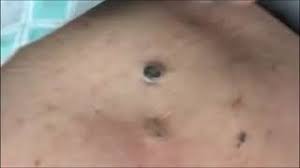 Abidjan has been locked down since march 23. Giant Blackheads Video Giant Blackheads Clips Nonoclip Com