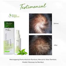 Obat Botak Mujarab Herbal Tanpa Efek Samping Atasi Rontok Parah Di 2020 Rambut Rontok Pertumbuhan Rambut Rambut