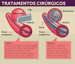 Estos tipos de aneurismas se pueden presentar en cualquiera de los vasos sanguíneos que irrigan el cerebro. Aneurisma Cerebral O Que E Quais Os Sintomas Hcor