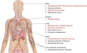 Image result for Pulmonary Intoxicant