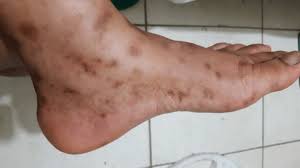 Image result for brown patches on the feet