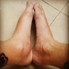 Apply sunscreen before and after laser tattoo removal to minimize changes in your skin pigment. Feet And Ankle Swelling After Leg Tattoo Expat Musings