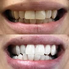 Pin Auf 8 Schritte Anleitung Fur Das Perfekte Aktivkohle Zahn Bleaching