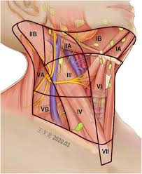 Management of Lateral Multiple-Level Metastasis in N1b Papillary Thyroid  Microcarcinoma