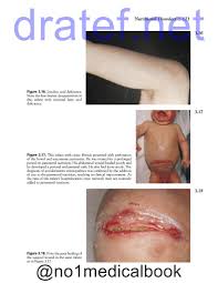 Desquamation (skin coming off in scales) psoriasiform (large white or silver flakes) pityriasiform (branny powdery scale) lichenoid (apparent scale is tightly adherent to the skin surface) keratotic (horny scale) exfoliation (peeling skin) maceration (moist peeling skin) verrucous (warty). 0134 New Born Disease Fsh Lh Flickr