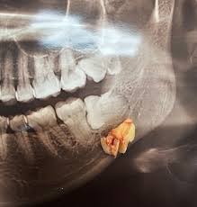 🇫🇷 dent de sagesse incluse extraction chirurgicale radiographie
