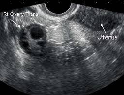 We did not find results for: Normal Ovary Ultrasound How To