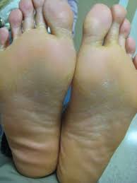 A less severe form of xerosis is xeroderma or normal dry skin. Xerosis Dry Skin Dermatology Advisor