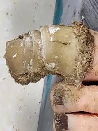 Successful Toenail Removal Procedure