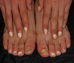 Leukonychia Definition Causes Treatment Prognosis