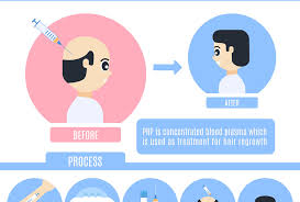 Spikenard oil is known for promoting the growth of hair and slowing down the graying process of graying. A Guide For Prp Therapy For Hair Loss