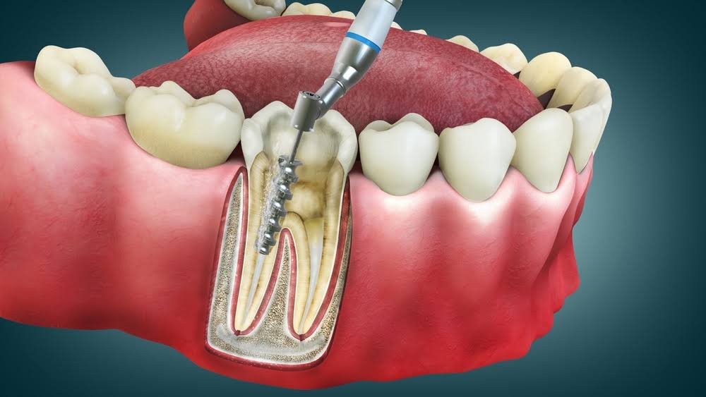 Root Canal product image