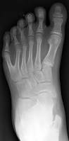 Image result for Polydactyly