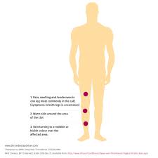 Signs And Symptoms Of Deep Vein Thrombosis