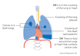 stage 4 lung cancer cancer research uk