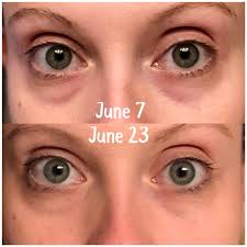 Neo-filler results after 12 weeks