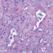 Early symptoms of mesothelioma are more often caused by other things, so at first people may ignore them or mistake them for common, minor ailments. Epithelioid Mesothelioma Epithelial Cell Prognosis Treatment