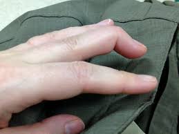As results above indicate that splinting is effective. Splinted Learning To Cope With Mallet Finger The Pathless Wood