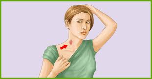 Provided it is in the right reason, you can cover the hickey if it is on your neck using a scarf. How To Get Rid Of A Hickey 13 Simple Ways