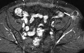 Physical exam should not be used to rule out a pelvic fracture in unconscious patients, but it can nearly definitively rule it in. Postoperative Iliac Crest Avulsion Fracture Cmaj