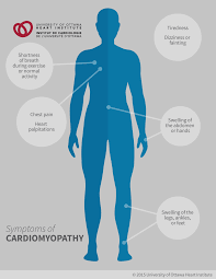 Image result for Cardiomyopathy