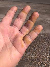 Webmd symptom checker helps you find the most common medical conditions indicated by the symptoms skin bumps and yellow skin including hives, chickenpox (varicella), and cirrhosis (liver). Are These Yellow Spots I M Getting On My Hands Normal Medical