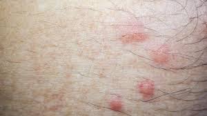 Image result for flea bites