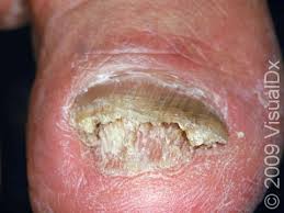 Image result for onychomycosis