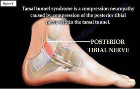 Tarsal Tunnel Syndrome Back In Action