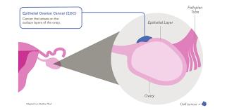 The most commonly adopted ovarian cancer staging system is the figo staging system. Ovarian Cancer Gsk Us