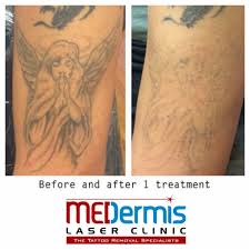 First, before learning how to remove tattoos at home fast and naturally, you might need to look over some of the most common reasons for people to get your tattoos removed. How To Get Rid Of A Stick And Poke Tattoo Medermis Laser Clinic