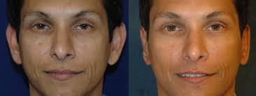 Ear “Pinning” (Otoplasty)