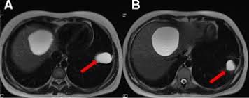 Gharbi classification pure fluid collection. A Very Rare Case Hydatid Cyst Surrounding Uterus And Magnetic Resonance Imaging Findings In The Pregnant Patient Sciencedirect