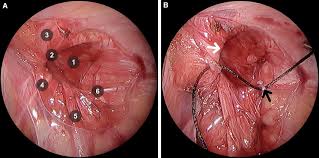 Image result for Inguinal hernia man